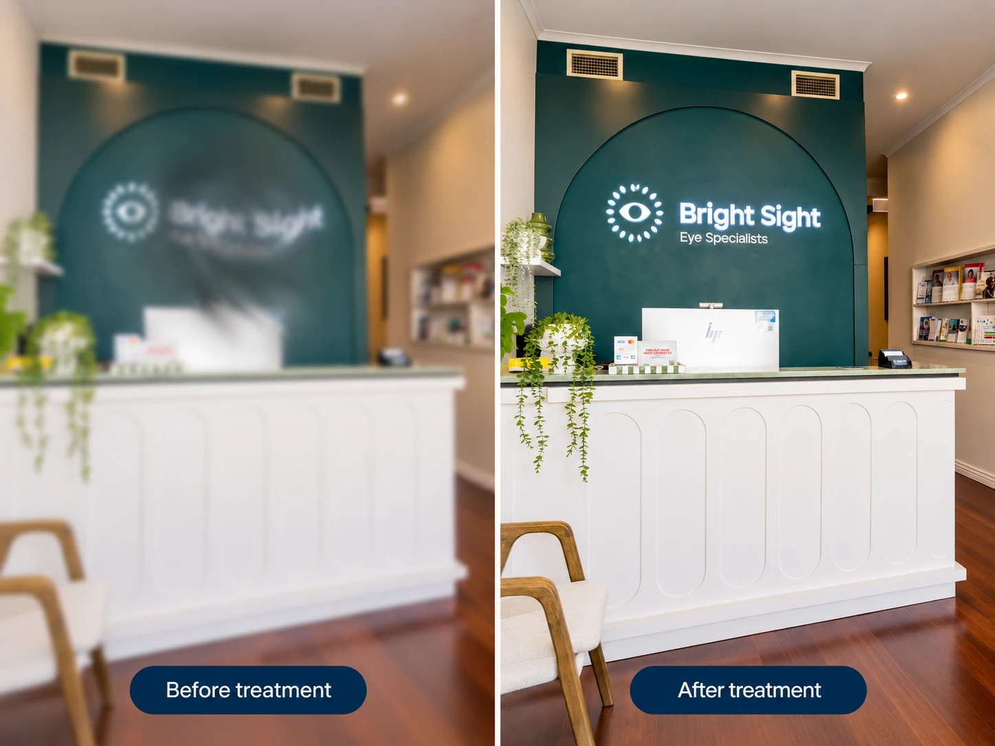 Illustration of blurred vision before treatment and clearer vision after intravitreal treatment