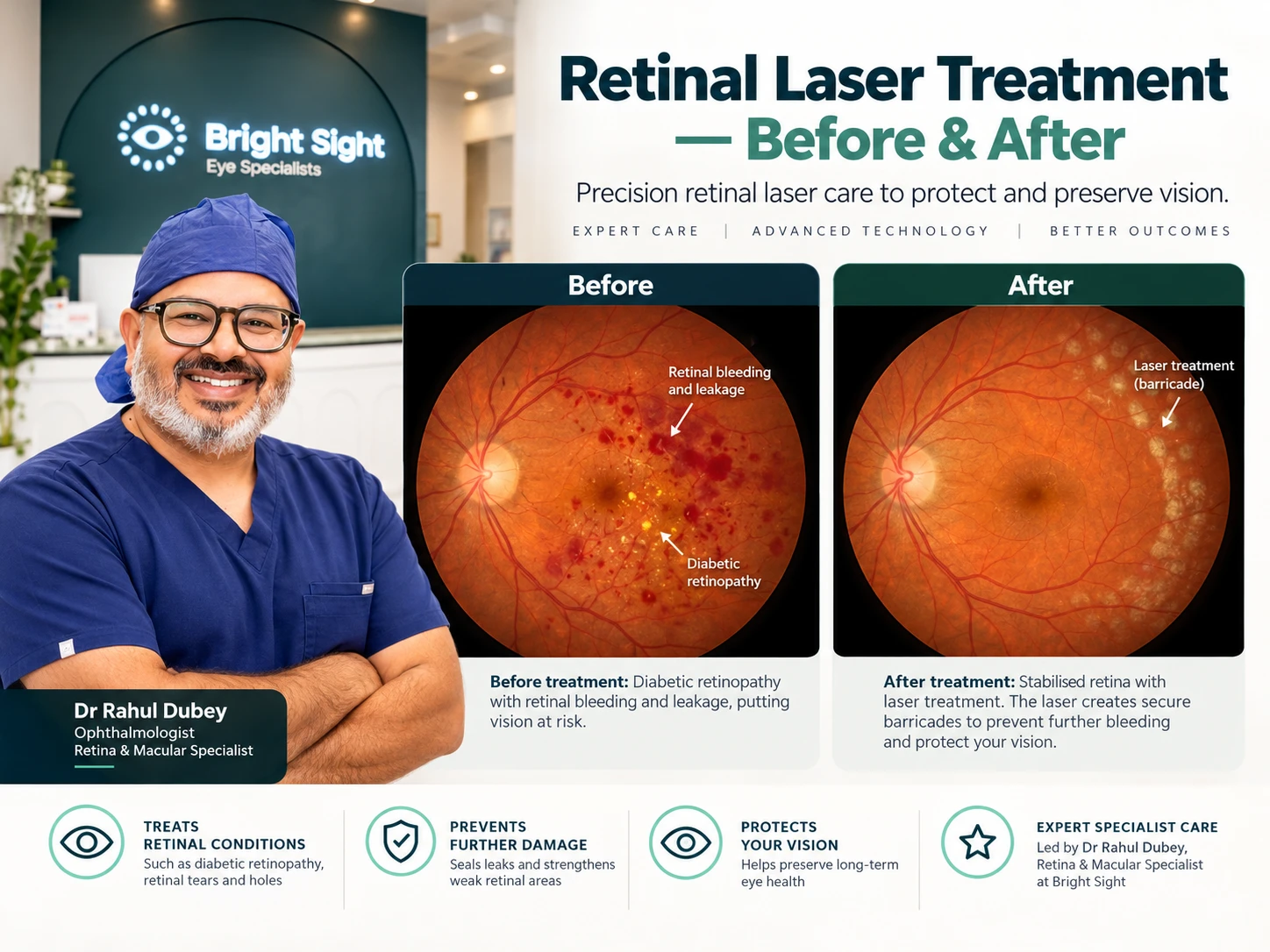 Illustration comparing retinal bleeding and leakage before laser treatment with a treated retina after laser